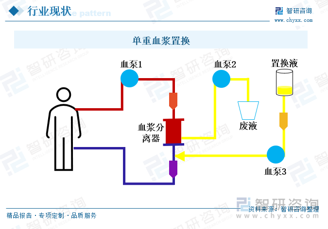 單重血漿置換